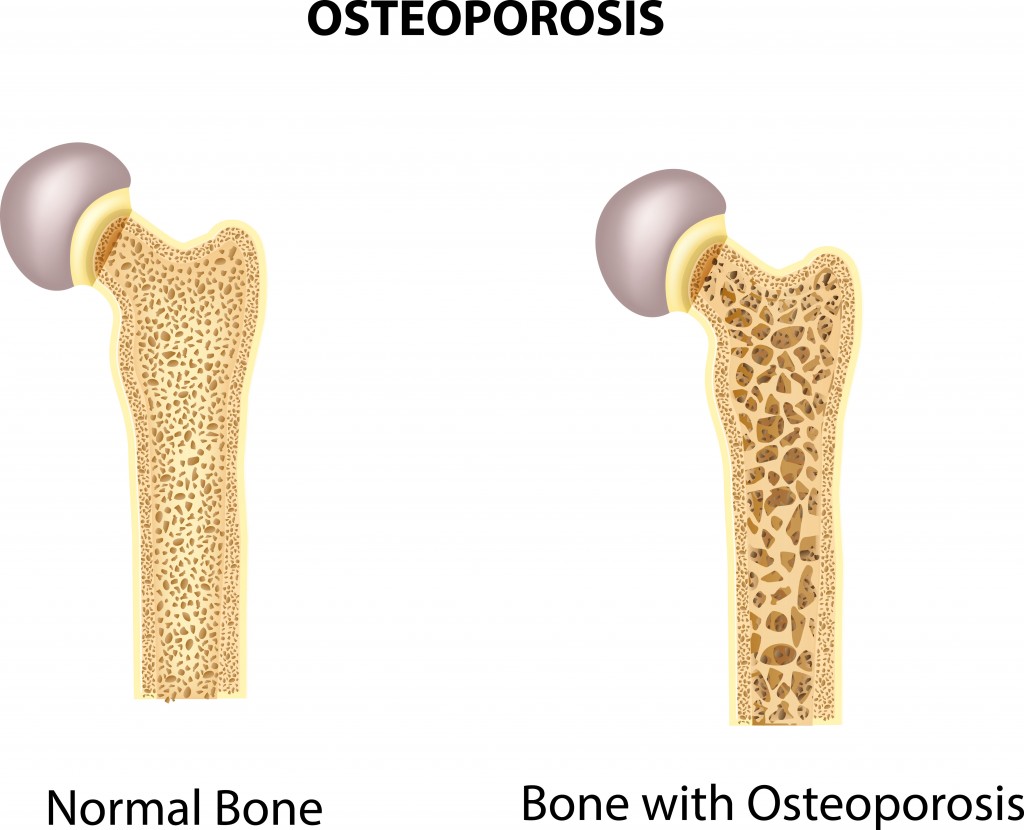 An illustration of two different hip bones. One is healthy, while the other has noticeable bone loss from osteoporosis.