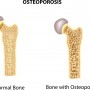 An illustration of two different hip bones. One is healthy, while the other has noticeable bone loss from osteoporosis.